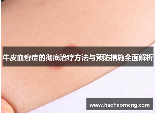 牛皮血癣症的彻底治疗方法与预防措施全面解析